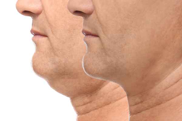 HIFU - Breakthrough in Anti - ageing 2 hifu results Luton