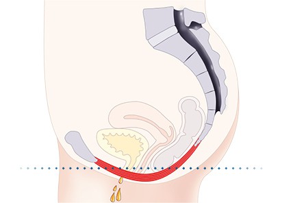 Pelvic-Floor Muscle Repair 5 Pelvic floor muscles Luton