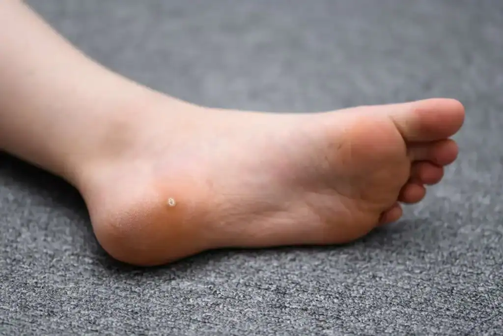 Cryotherapy For Warts And Also Verrucas 2 Image of verruca on the bottom of the foot that able to be treated with Cryotherapy Luton