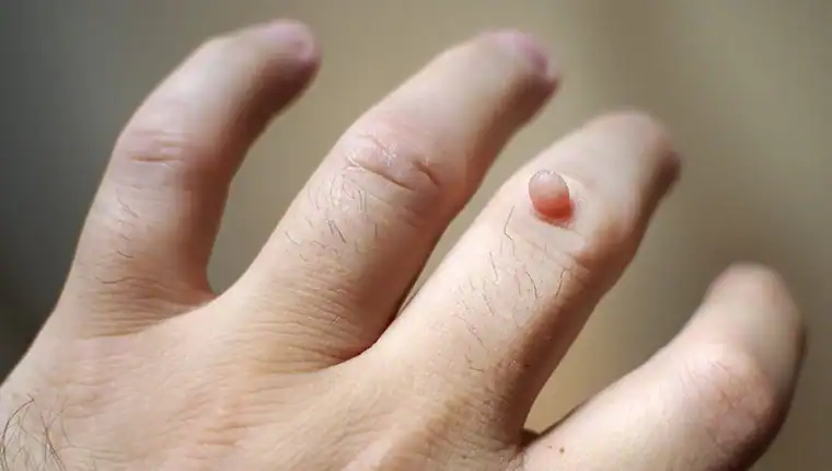 Cryotherapy For Warts And Also Verrucas 1 Image of blemish that Cryotherapy Luton can remove with Lipo 360.