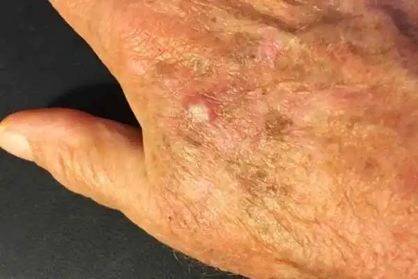 Cryopen For Actinic Keratoses 1 Image of Actinic keratoses Luton on a person hand