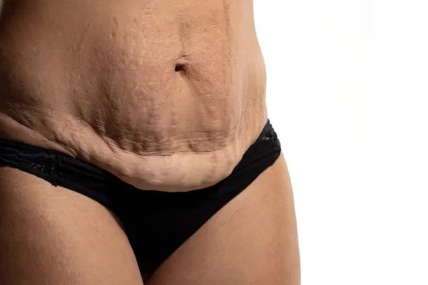 The science behind skin tightening Luton picture of a woman's sagging skin on the stomach